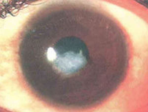 фото лейкомы глаза